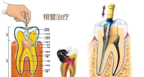 根管治疗完了会痛吗(根管治疗打牙桩痛吗)图2