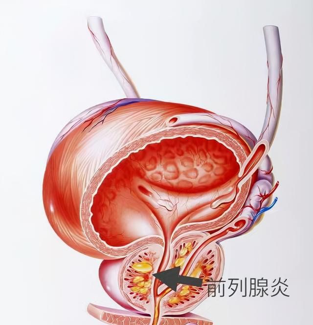 前列腺增生的“苦”，懂得都懂！3种一线治疗药物，医生一文说清