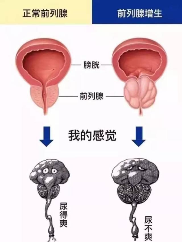 前列腺增生的“苦”，懂得都懂！3种一线治疗药物，医生一文说清