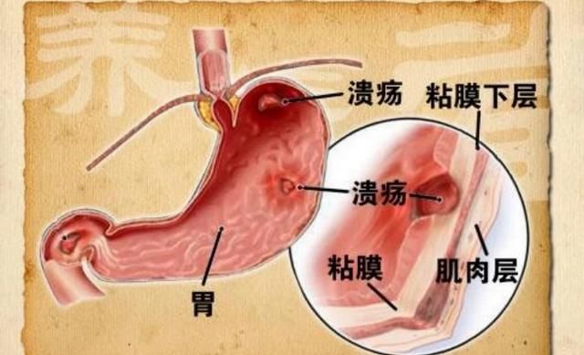 萎缩性胃炎早晨空腹喝蜂蜜水好吗图7