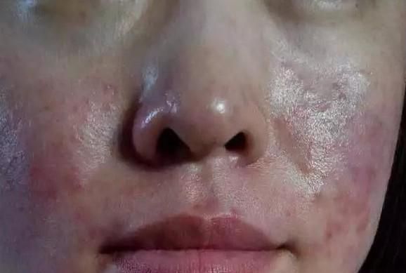 脸上到底能不能用激素药膏，裸脸治疗是否真的有效