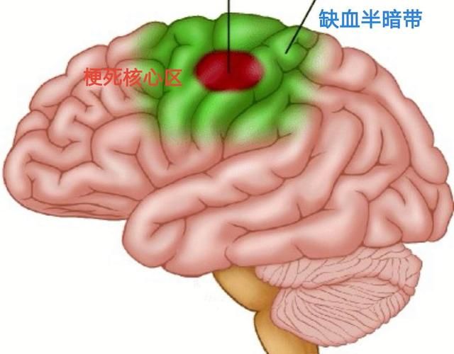 脑梗能治好吗,脑梗能治好吗60岁的人图4