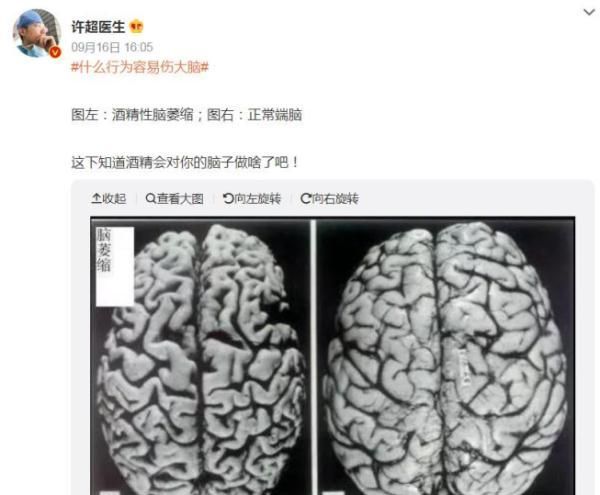 喝酒后，看看酒精对你的脑子做了什么？看完再也不要多碰了