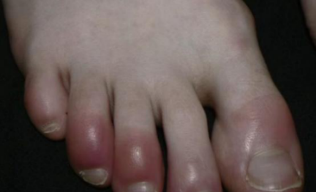 阳过后出现这些皮疹？需引起重视！教你几招加速康复