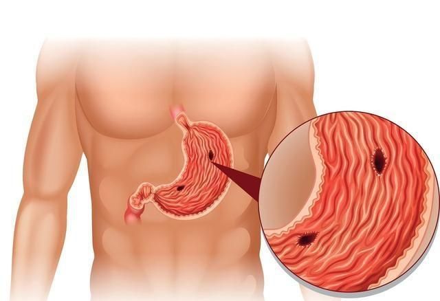 胃癌要发生时早期会有哪些信号图1