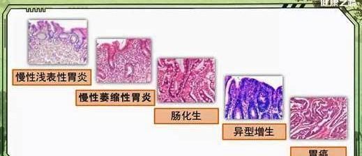 胃癌要发生时早期会有哪些信号图22