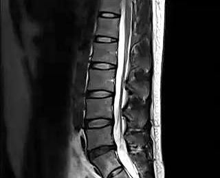 慢性腰痛敷热盐效果怎样呢(慢性腰痛敷热盐的方法)图3