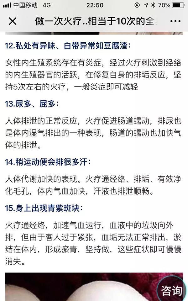 笑喷！中医专家一句话点评权健火疗：和毛巾热敷没有区别