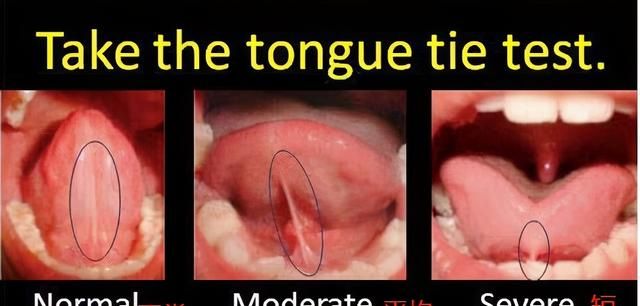宝宝喝水“嘴漏”、咬字不清？快看是 不是舌头被「锁住」了