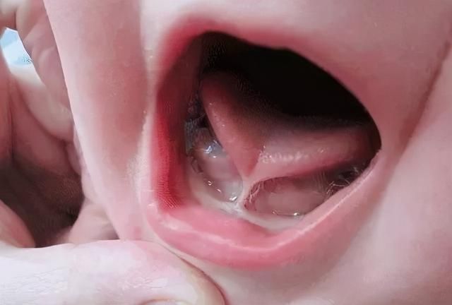 宝宝喝水“嘴漏”、咬字不清？快看是 不是舌头被「锁住」了