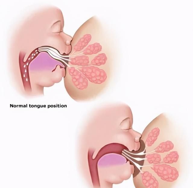 宝宝喝水“嘴漏”、咬字不清？快看是 不是舌头被「锁住」了