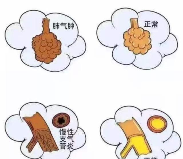 【肺气肿是怎么回事？需要治疗吗？】
