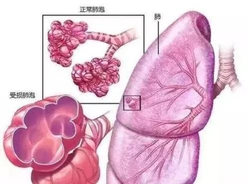 【肺气肿是怎么回事？需要治疗吗？】