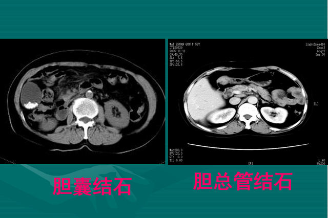 科普胆囊炎的临床症状及特点，常见胆道疾病的预防和治疗