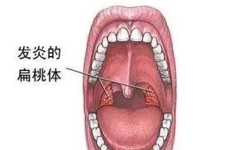 扁桃体发炎有什么饮食上的禁忌吗
