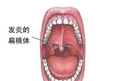 世界杯到了，扁桃体发炎！这5大饮食禁忌一定要知道