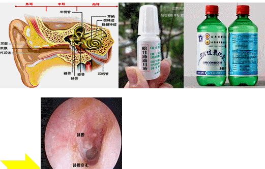 治疗外耳道炎及中耳炎的药物选用