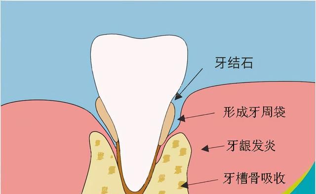 牙缝里的牙结石，如何清除干净？3个办法是不少人的选择