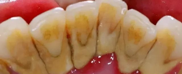 牙缝里的牙结石，如何清除干净？3个办法是不少人的选择