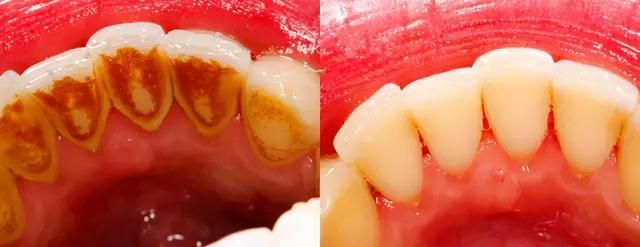 牙缝里的牙结石，如何清除干净？3个办法是不少人的选择