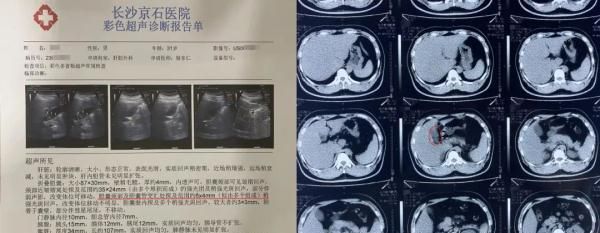 肉食爱好者天天吃肉不停歇，胆囊养出近20颗“小金豆”