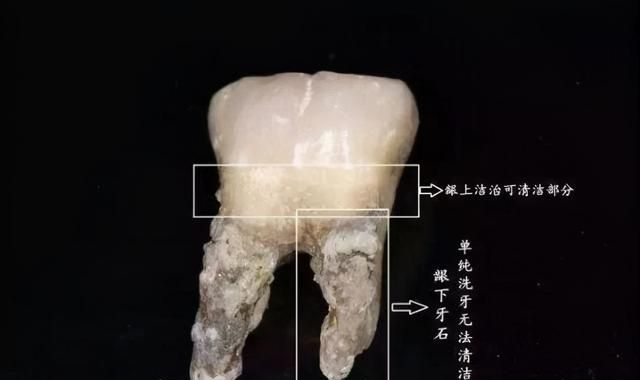 洗个牙要2000+ 不是说洗牙很便宜的吗？我这是被坑了吗？