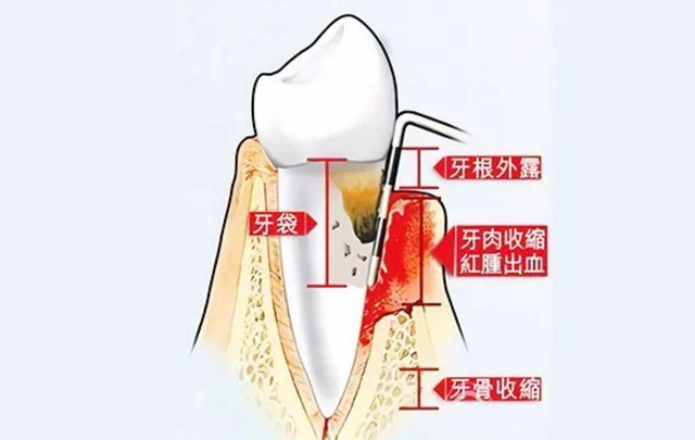 洗个牙要2000+ 不是说洗牙很便宜的吗？我这是被坑了吗？