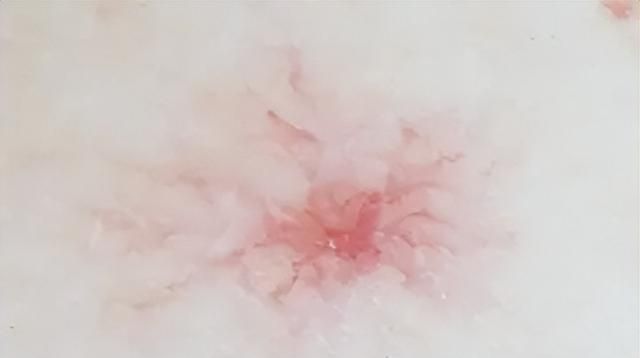 身上起的小红点是怎么回事？可能和4个问题有关，您可别心存侥幸