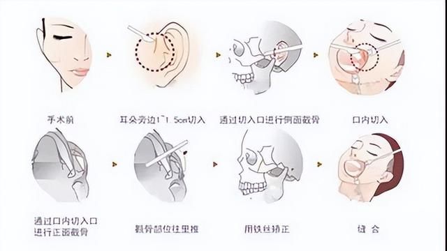 求助！颧骨内推到底能推到什么程度？颧骨内推风险大吗？