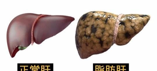 脂肪肝如何消除？4步消除脂肪肝的良方！建议收藏好