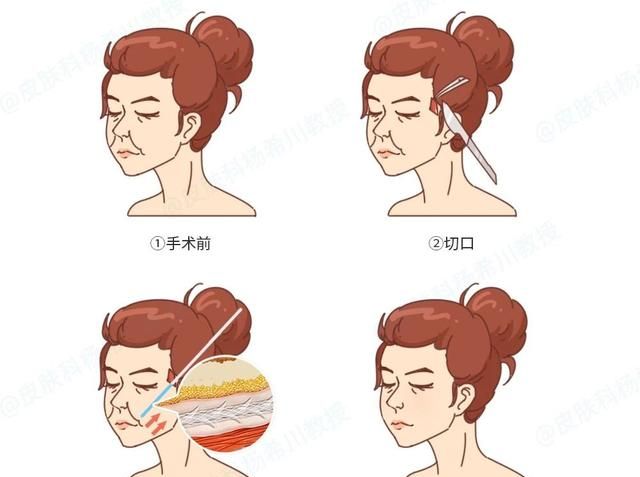线雕这种医美手段或许让你重返青春不是梦