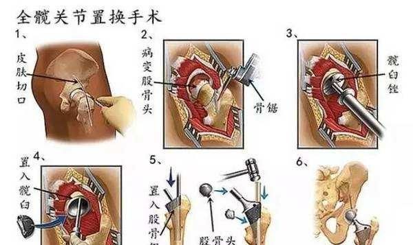 股骨头坏死置换