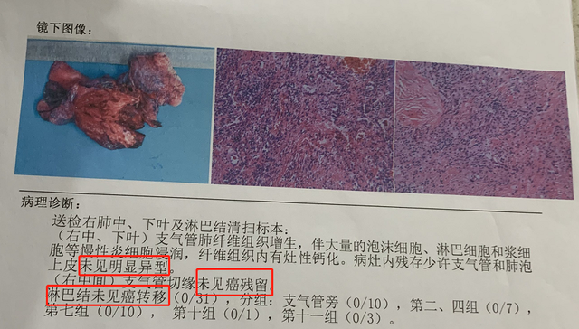 IIIB期肺癌伴淋巴结转移，靶向治疗后效果显著，癌细胞全被杀死