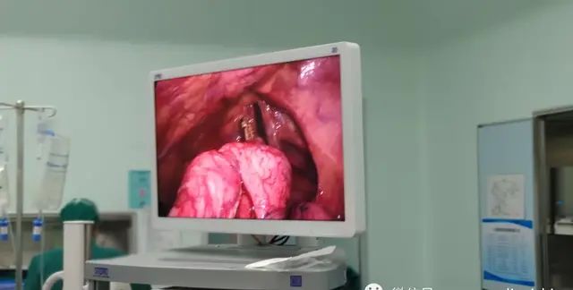 珠三角地区手术：漏斗胸改良NUSS手术+自发性气胸手术