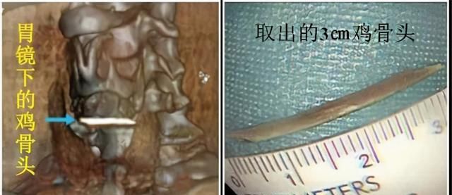 还在生吞猛咽？一不小心骨头就穿透食管了