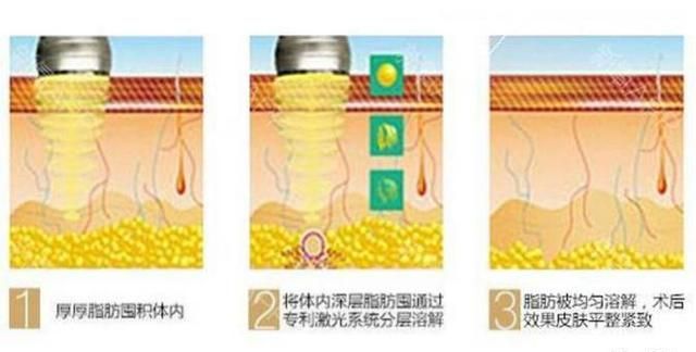 眼袋快要掉地上了，做个超微创热融就能去掉啦！