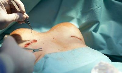女子花7.8万隆胸，手术效果让其焦虑自卑：4年不敢面对老公