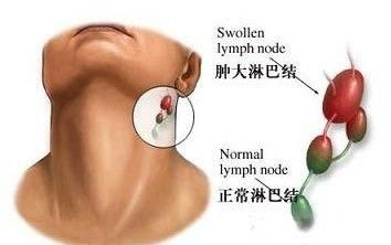 淋巴结肿大如花生米，专家却说：这不是淋巴瘤而是关节炎