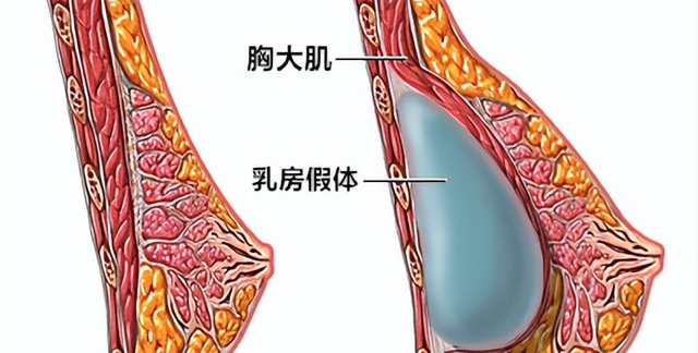 隆胸手术是怎么做的？隆胸后还能继续喂奶吗？答案全在这里