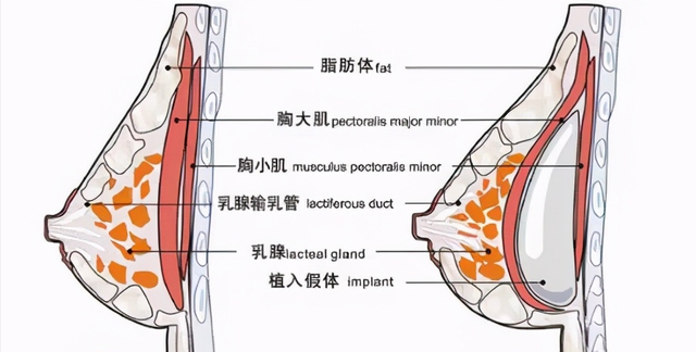 隆胸手术是怎么做的？隆胸后还能继续喂奶吗？答案全在这里