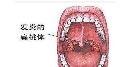 银黄颗粒有哪些功效,银黄止咳颗粒的功效与作用图3