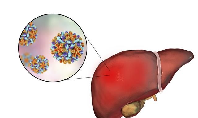 达到这个标准，乙肝才算彻底治愈了，主要还是靠这3个疗法
