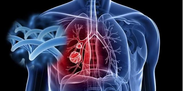 晚期肺癌也能实现治愈，生存5年、10年甚至更长时间