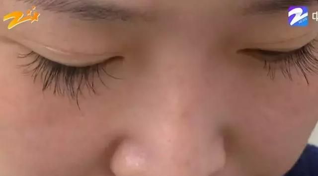 绍兴女子为隆鼻，花十万取自己肋骨，术后：鼻子歪、难呼吸！