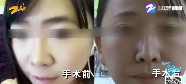 绍兴女子为隆鼻，花十万取自己肋骨，术后：鼻子歪、难呼吸！