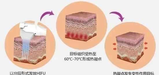 超声刀的效果真有那么神奇吗图3