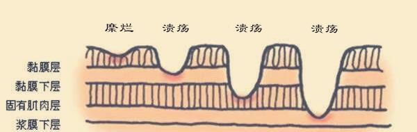糜烂性胃炎严重吗？是不是胃“烂掉”了？其实是这样的