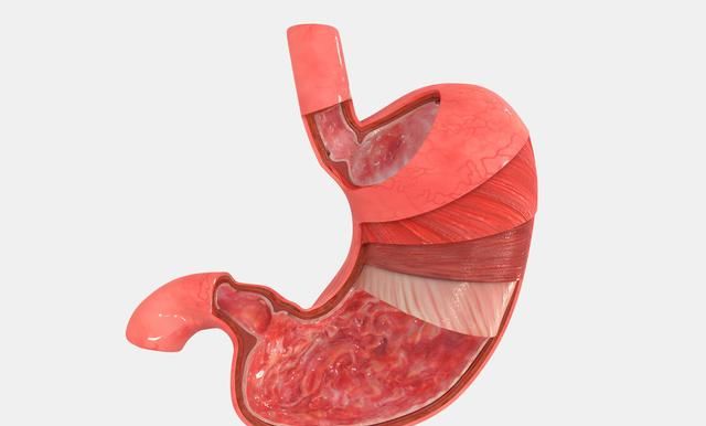 糜烂性胃炎严重吗？是不是胃“烂掉”了？其实是这样的