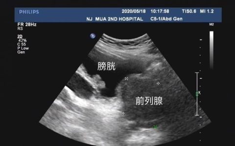 前列腺炎治疗效果如何
