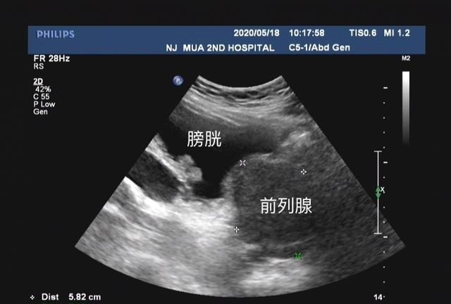 前列腺炎治疗效果如何图1